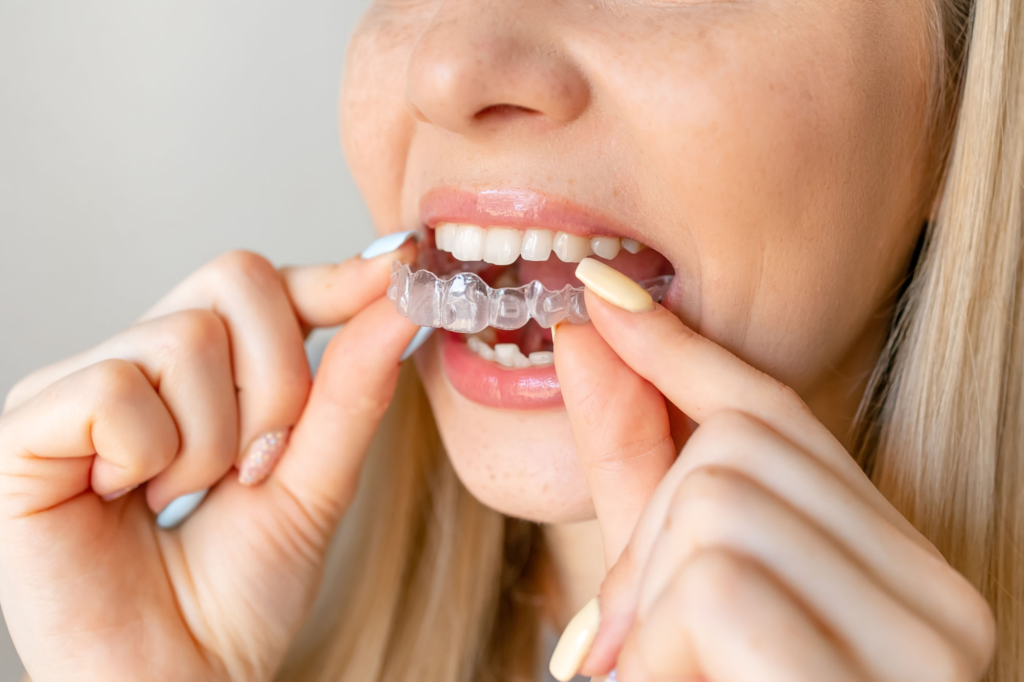 Dental Aligners: The Invisible Revolution Has a Price... But Which One?