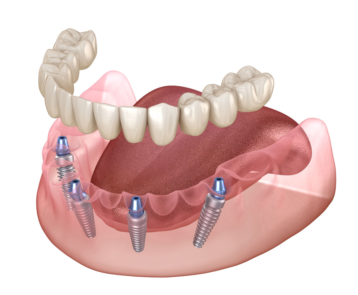 All-on-4: The Game-Changing Implant Technique!