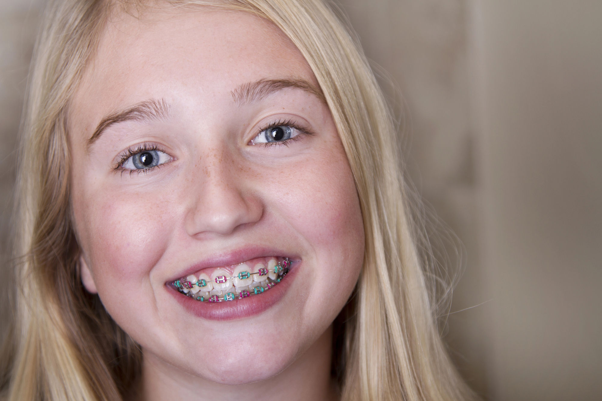 Braces are the most used orthodontic appliances among teenagers