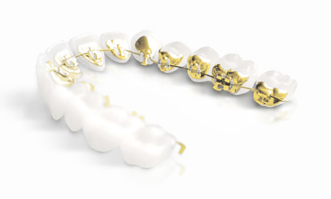 Incognito gold lingual braces