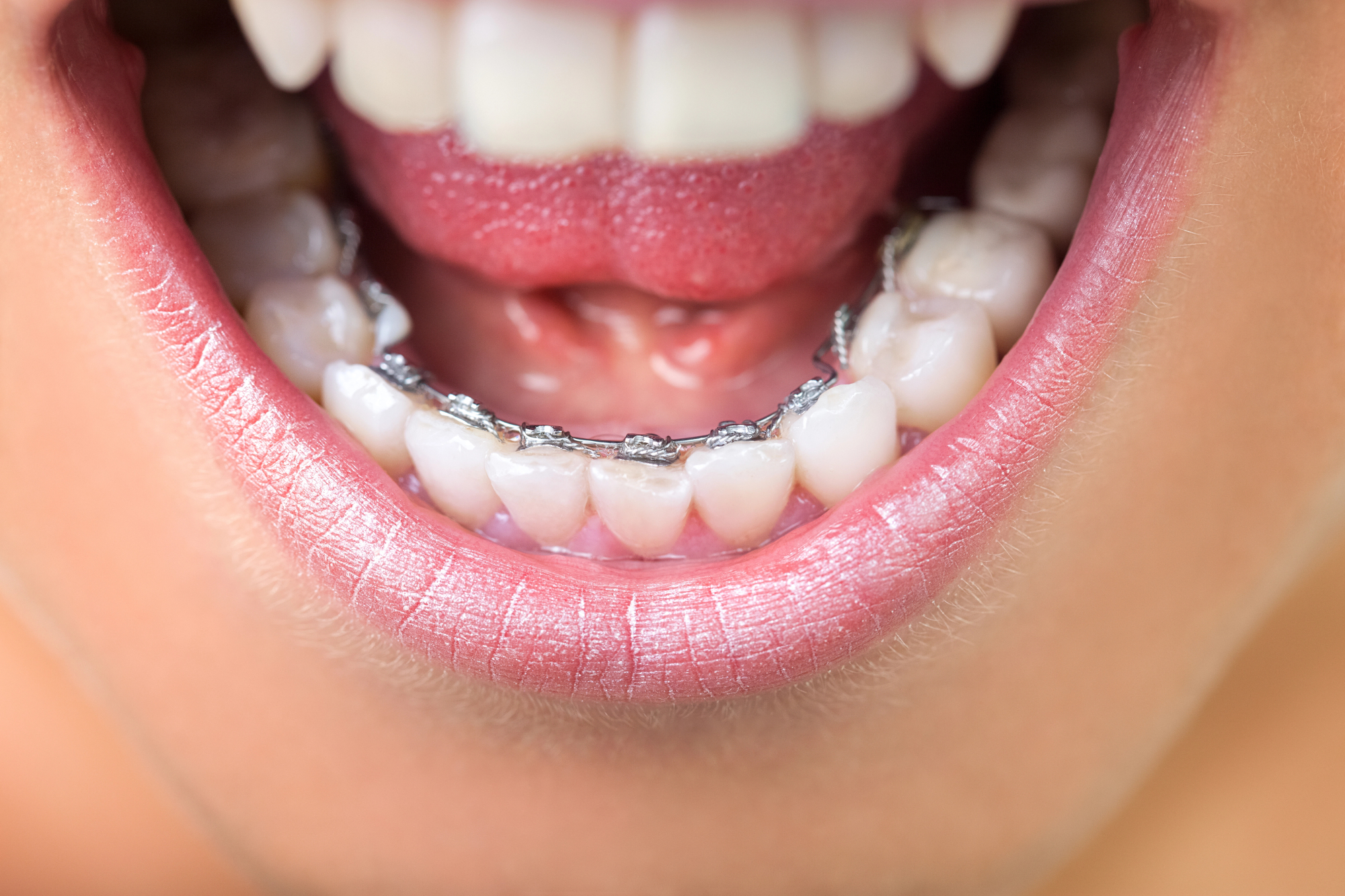 The Lingual Appliance: The Invisible Orthodontic Solution for a Perfect Smile