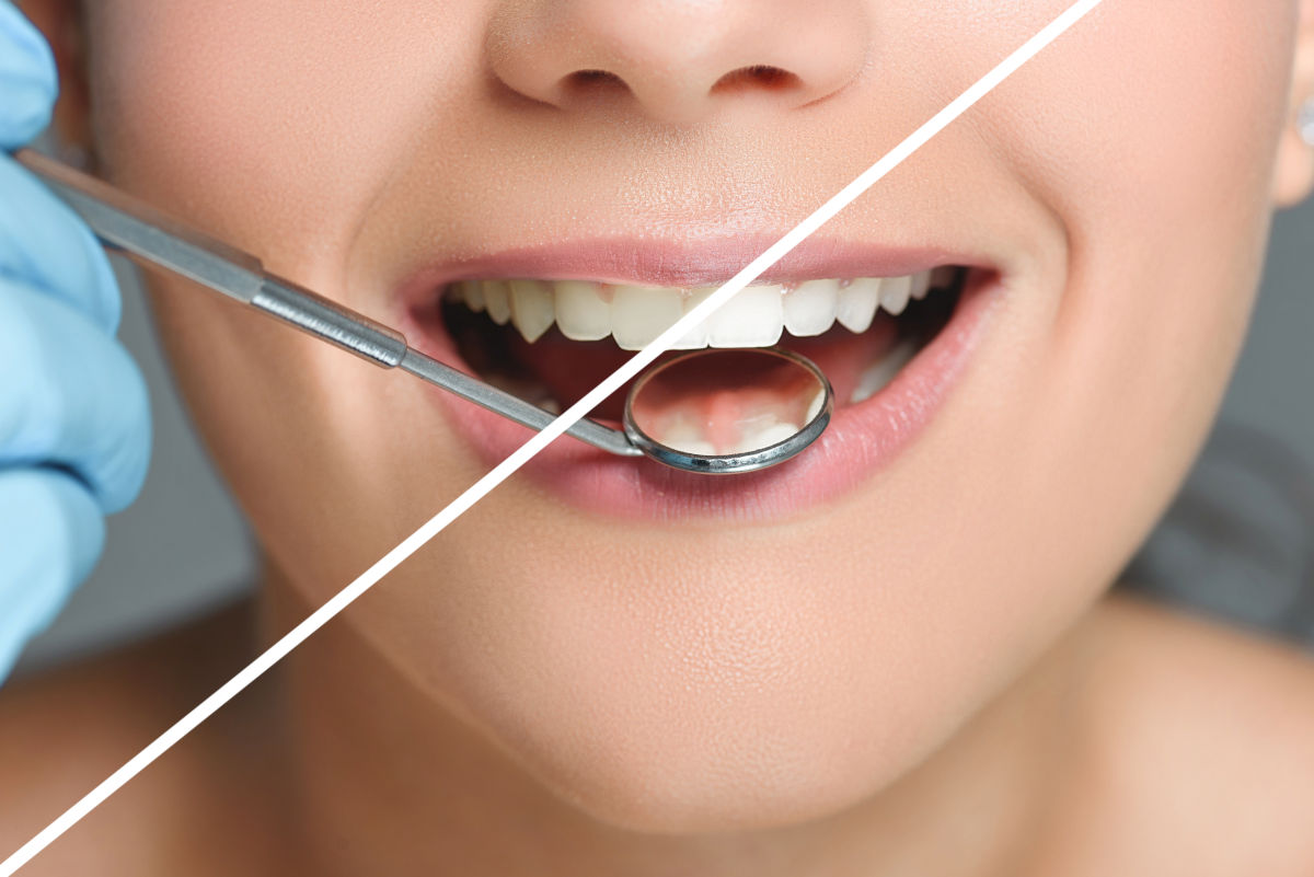 Teeth Whitening at the Dentist: Everything You Need to Know