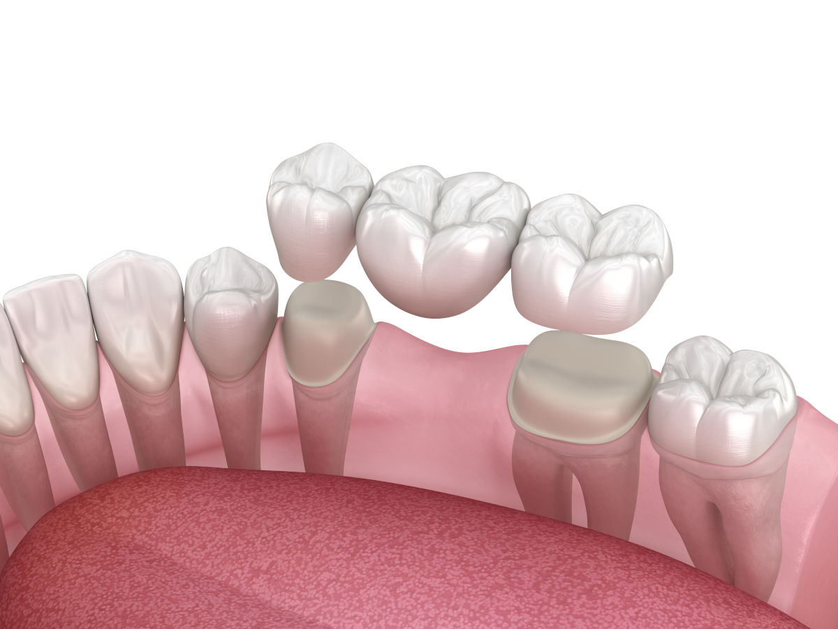The Dental Bridge: Everything About This Fixed Prosthesis