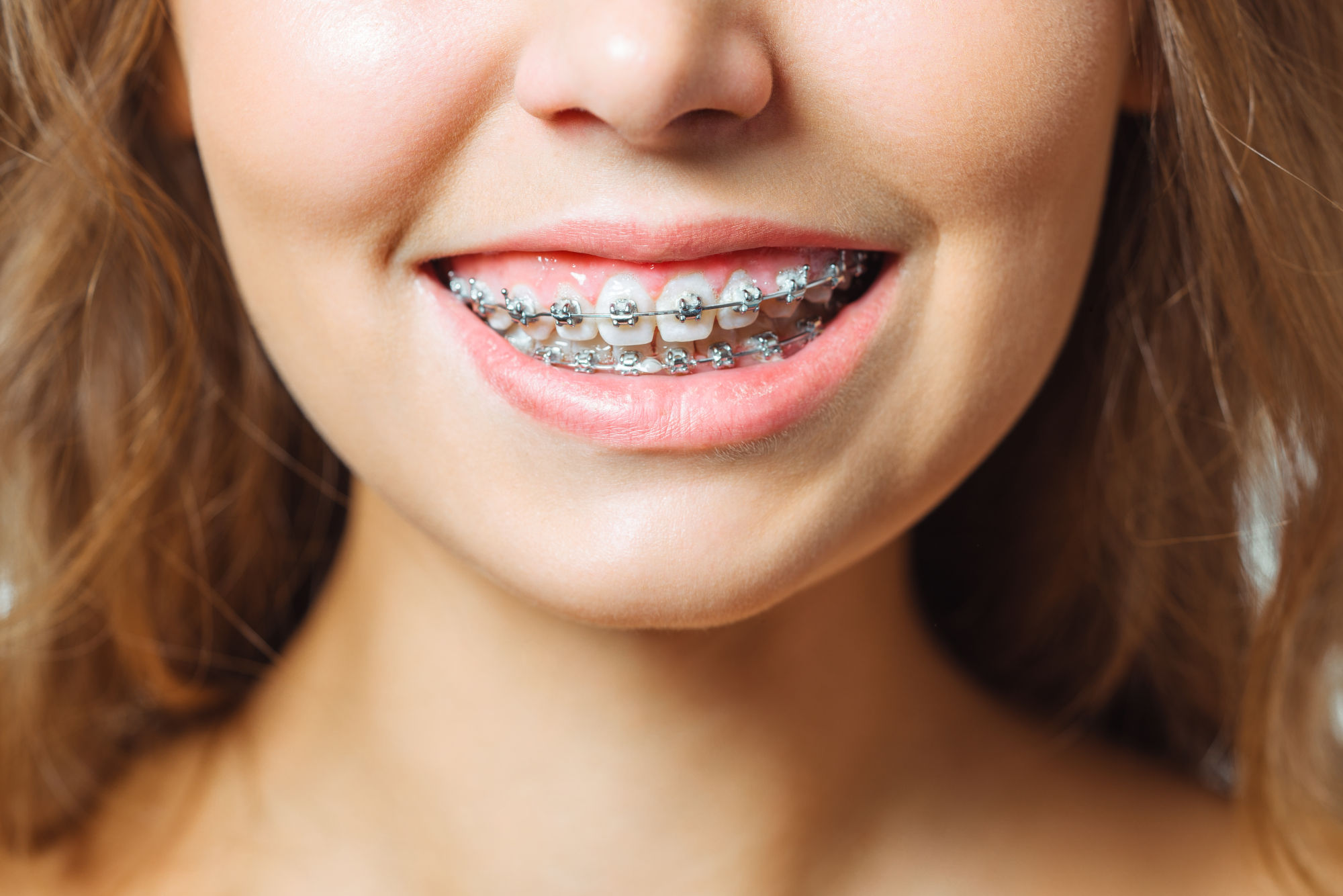 Types of Dental Braces in 2026: Metal, Ceramic, Lingual, and Clear Aligners Compared