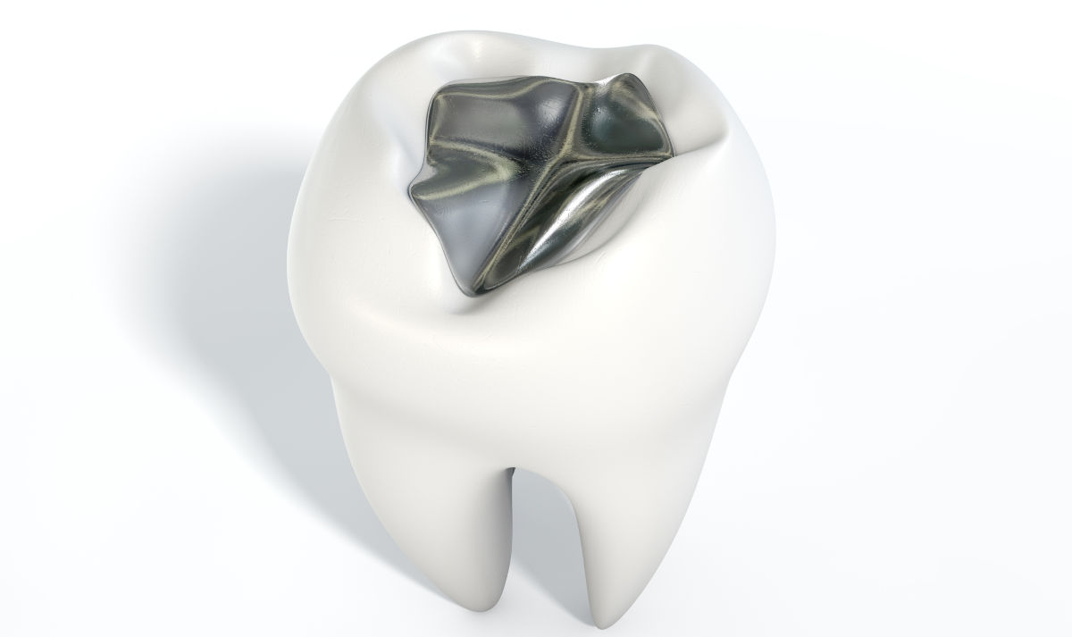 Dental amalgam filling