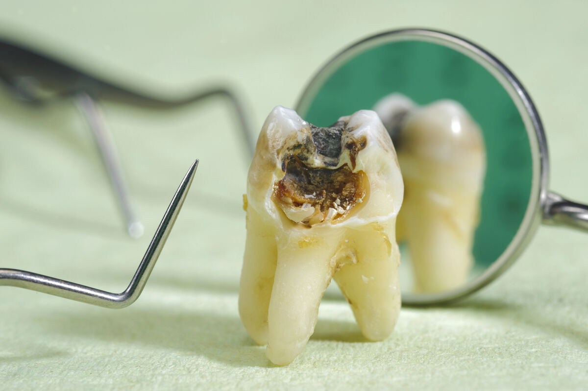 Dental Cavities in 2026: Causes, Symptoms, Treatments, and Prevention Guide
