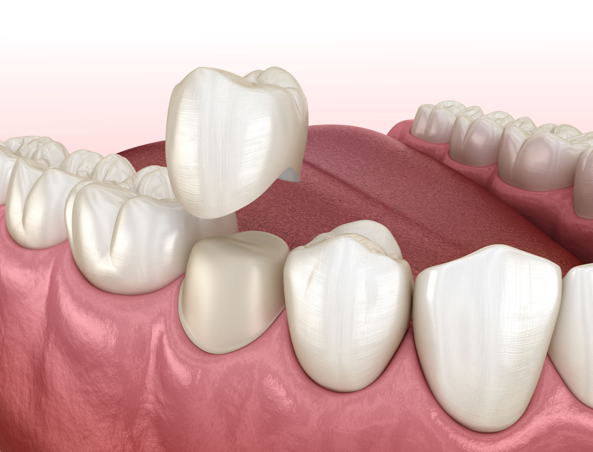 Dental Crowns in 2026: Complete Guide to Types, Costs, and Insurance Coverage