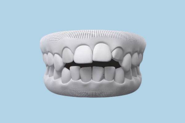 Dental Open Bite in 2026: Causes, Treatments, and Costs for Every Age