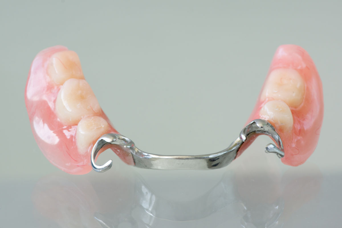 Cast metal partial denture: a comfortable and affordable removable solution