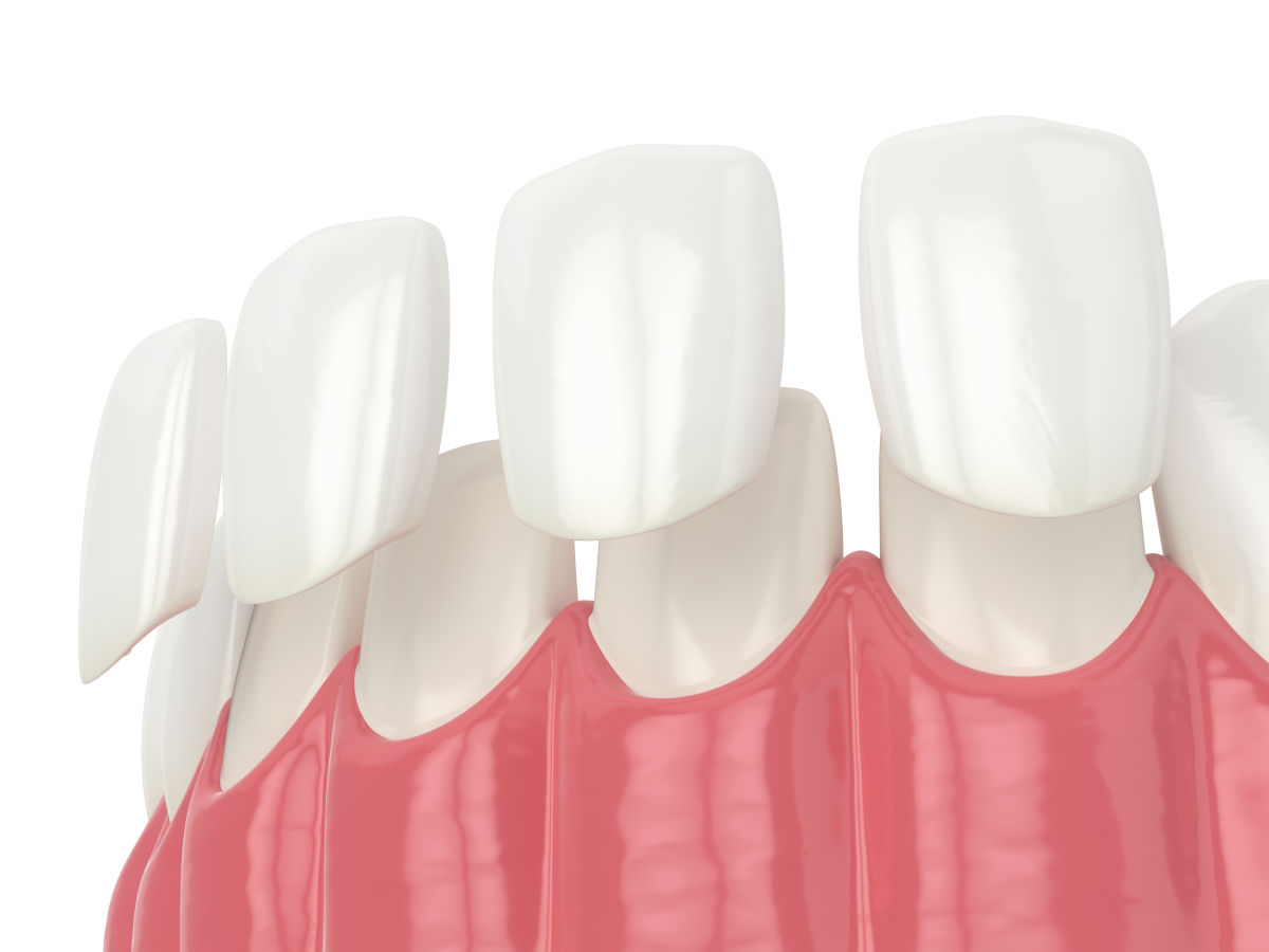 Dental Veneers in 2026: The Complete Guide to Costs, Types, and What to Expect