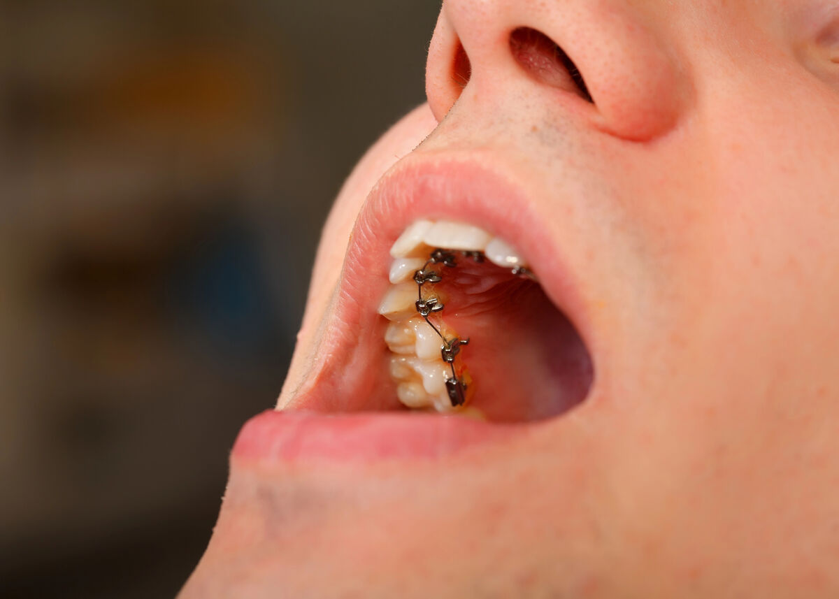 Lingual Orthodontics: The 100% Invisible Orthodontic Treatment