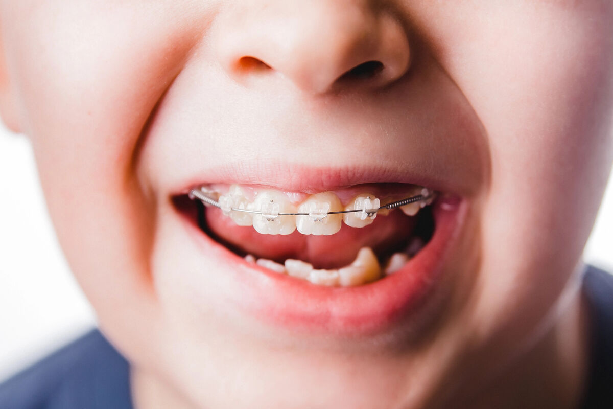 Young patient with a dental malocclusion treated with ceramic braces