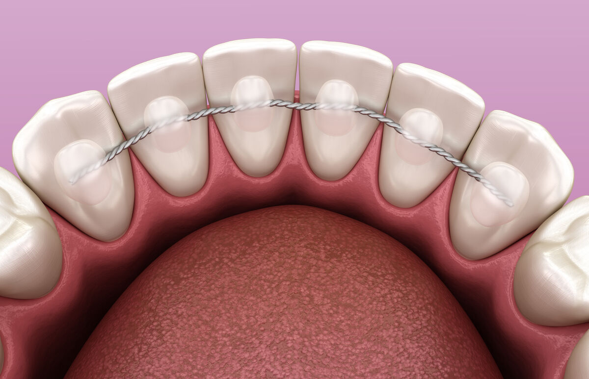 Discreet permanent orthodontic retainer placed on the inner side of the teeth