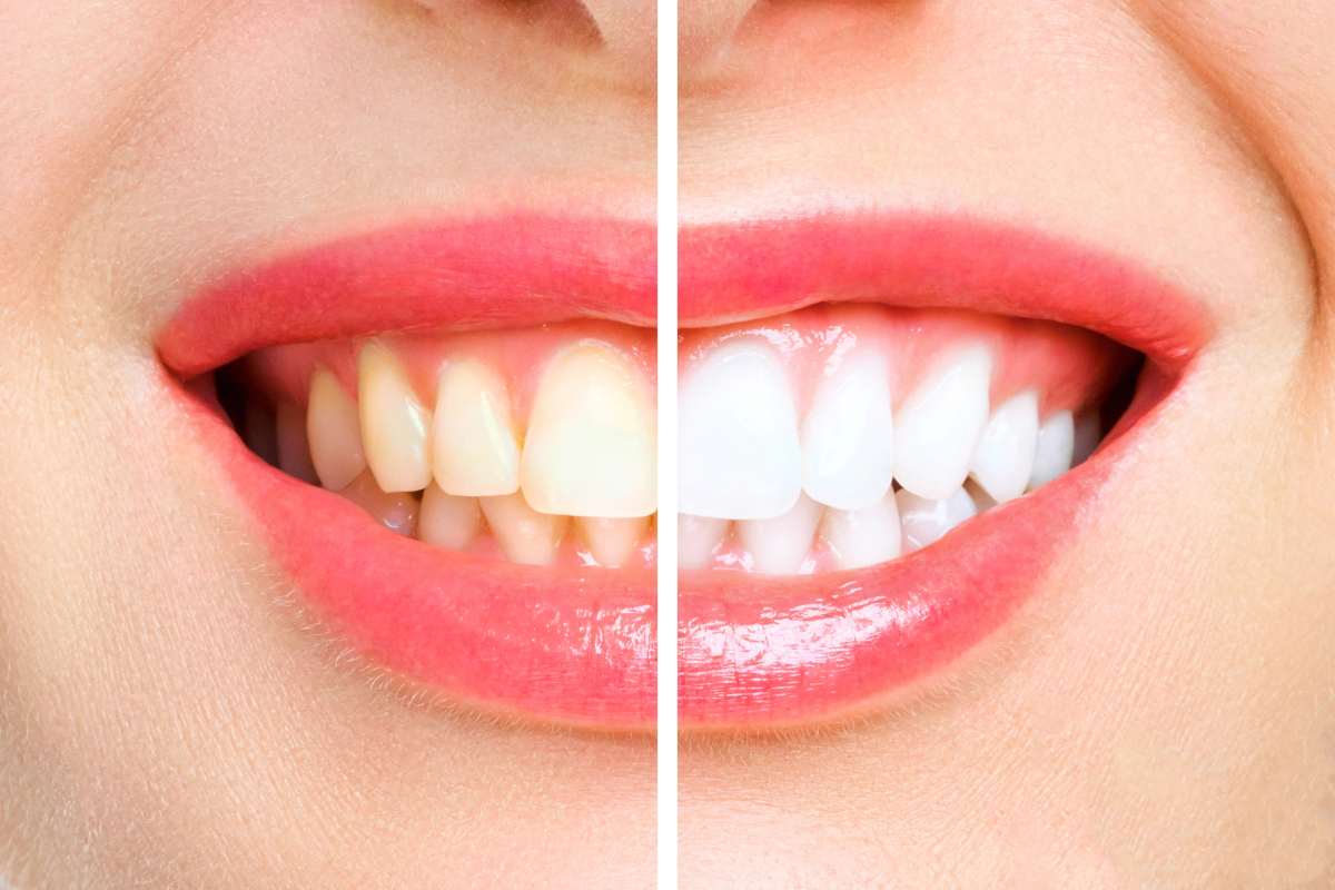 Teeth Whitening Reimbursement: Everything to Know