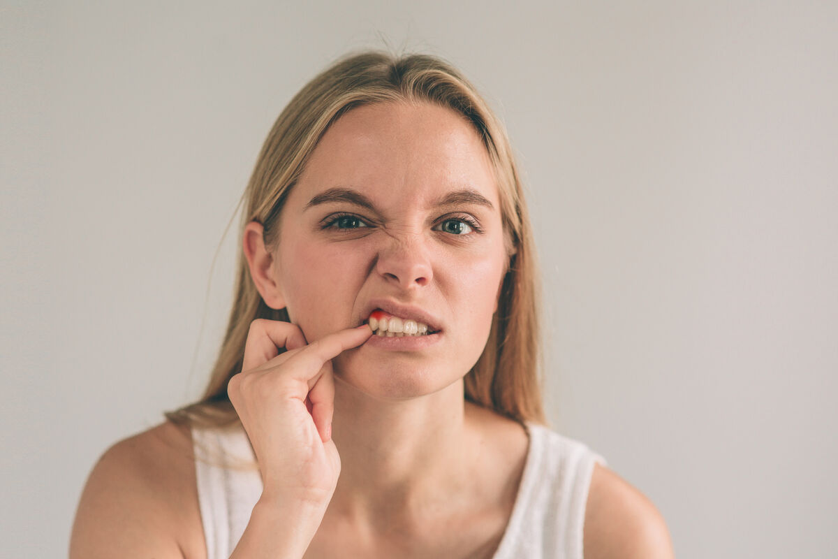 Gingivitis: Causes, Symptoms, and Treatments for This Gum Disease