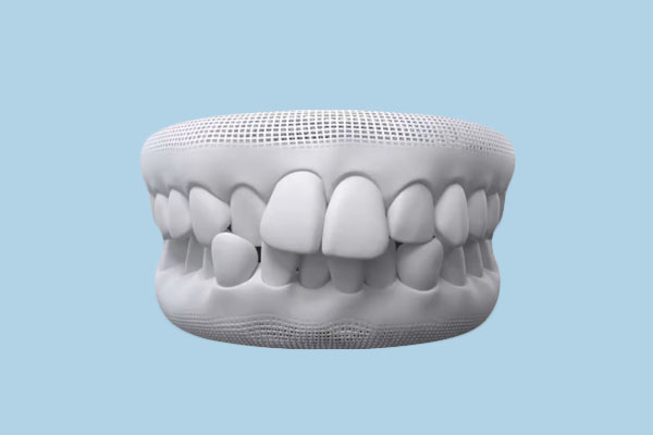 Overlapping Teeth: Causes, Risks, and Solutions