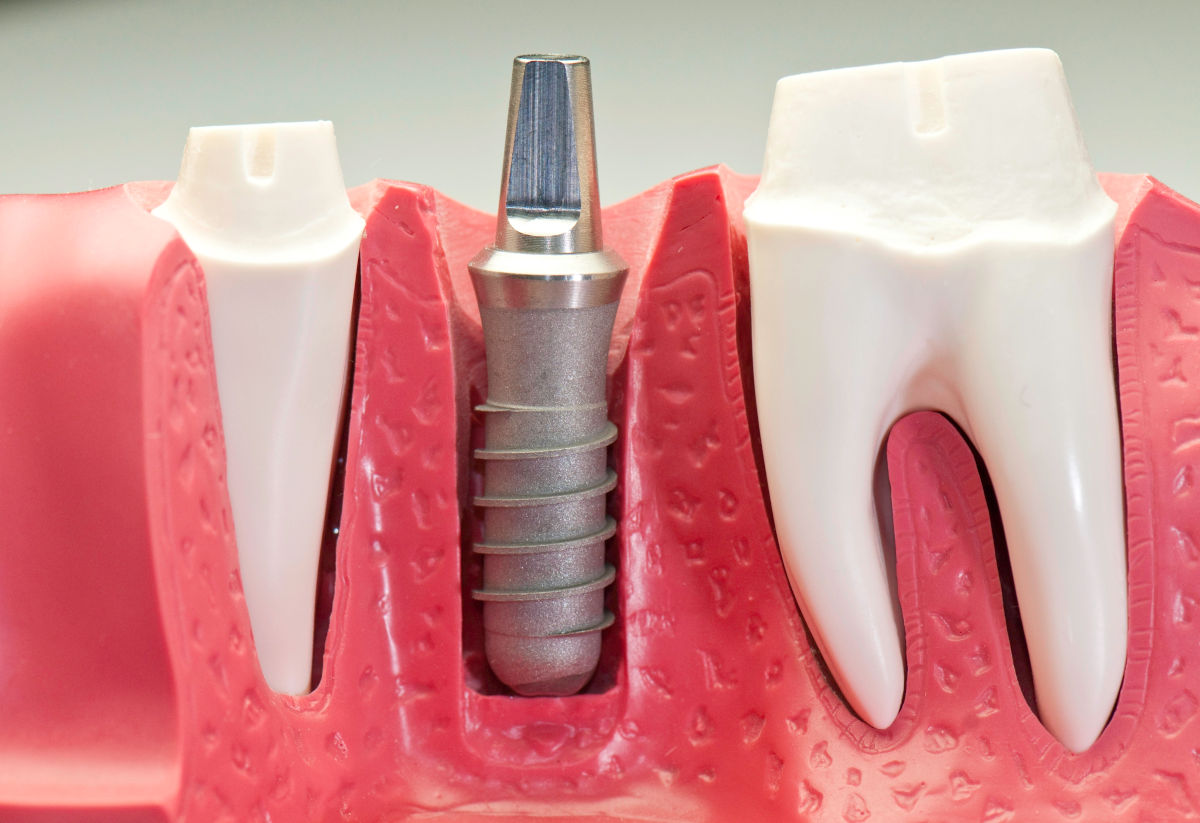 Affordable Dental Implants in 2025: The Ultimate Guide to Saving Money