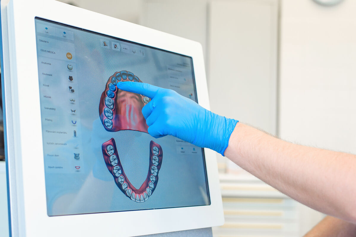 Example of a ClinCheck 3D simulation showing tooth movement