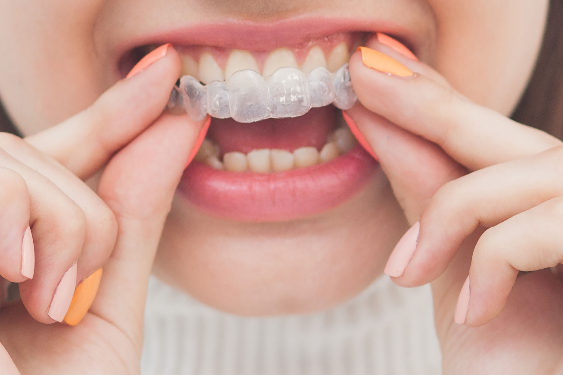 My Invisalign® Aligner Doesn't Fit: What Should I Do?