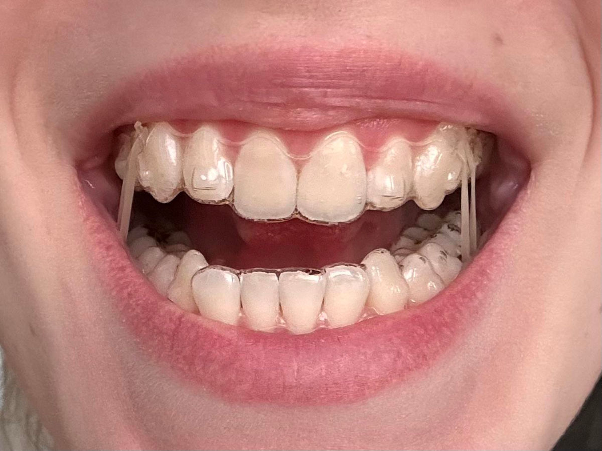 Invisalign treatment and elastics: explanations, duration, utility