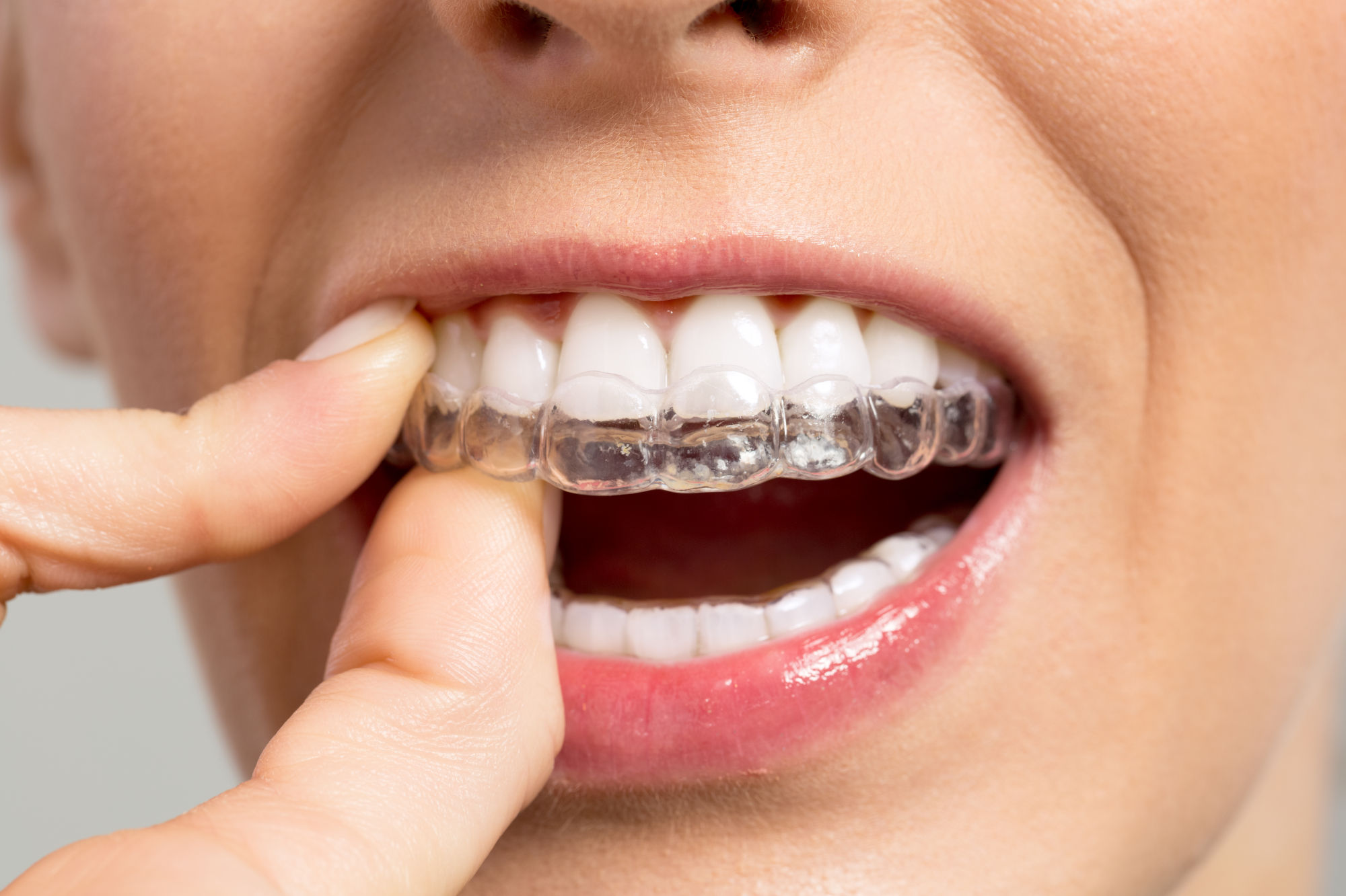 Invisible Braces: Discretion at the Service of Your Smile