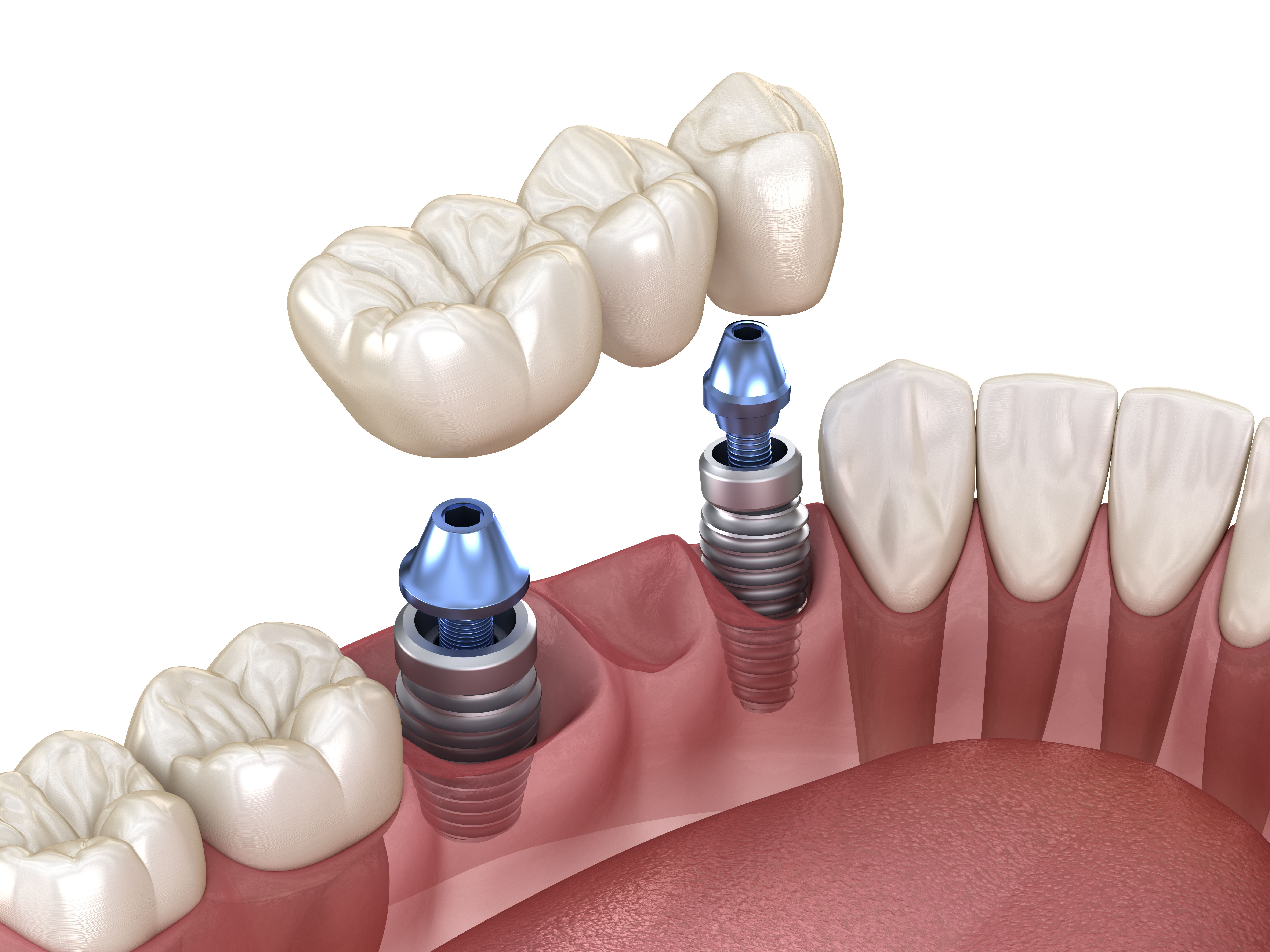 Implant-Supported Prostheses: The Fixed Solution to Get Your Smile Back
