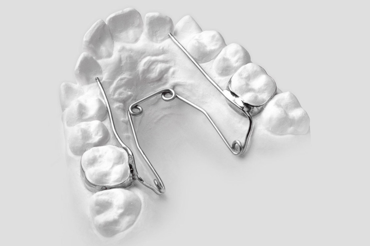 Quad Helix orthodontic appliance