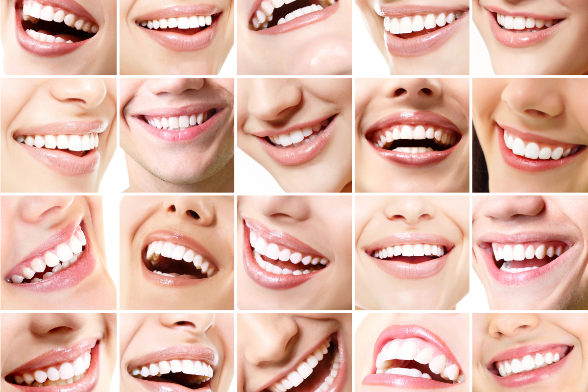 Example of aesthetic result obtained with dental veneers